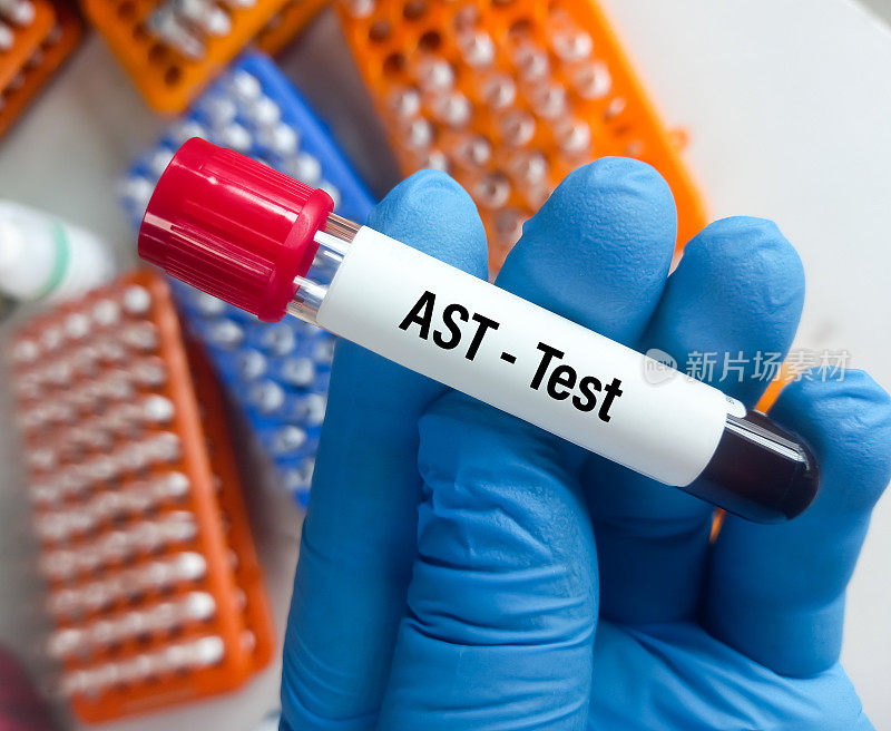 血液样本AST(天冬氨酸转氨酶)或SGOT测试，以帮助诊断肝脏损害或疾病。肝功能检查。