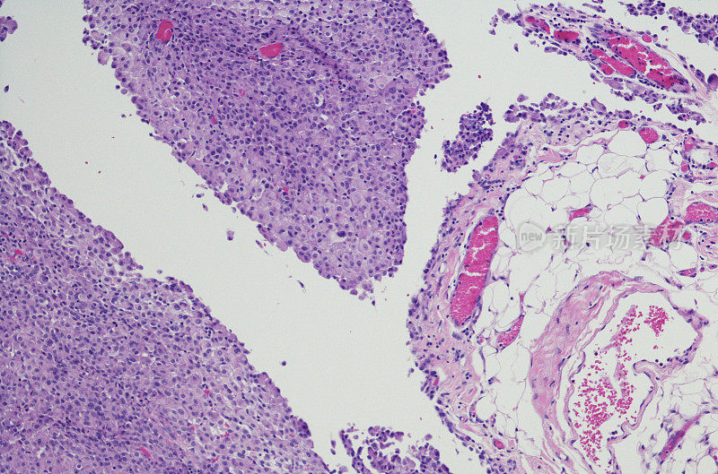 腹膜间皮瘤的显微照片。