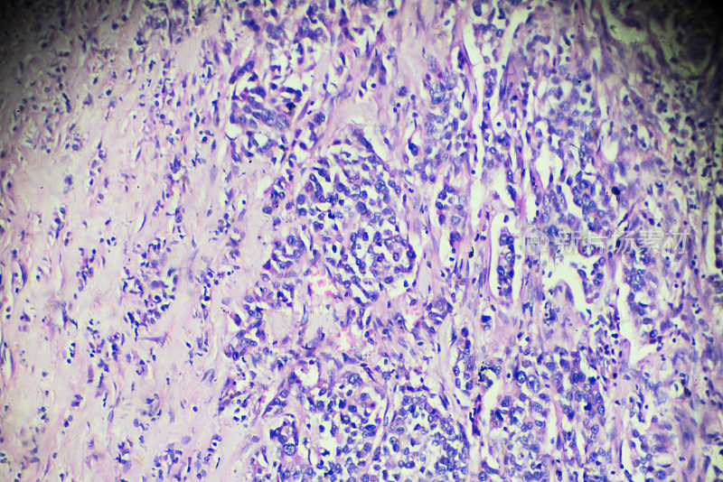 膀胱移行细胞癌的显微镜观察