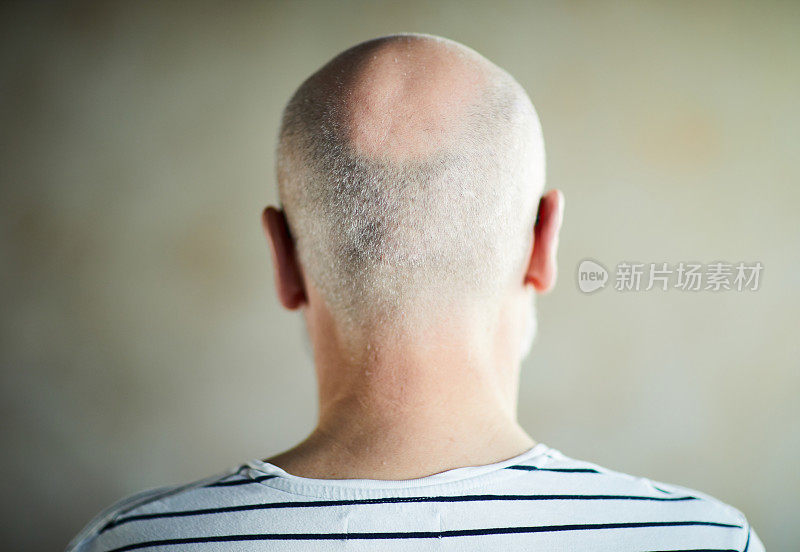 后视图无法辨认的成熟男子在剥毛衣遭受脱发，秃头男子
