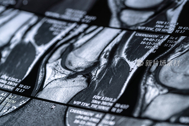 膝关节磁共振(MRI)扫描