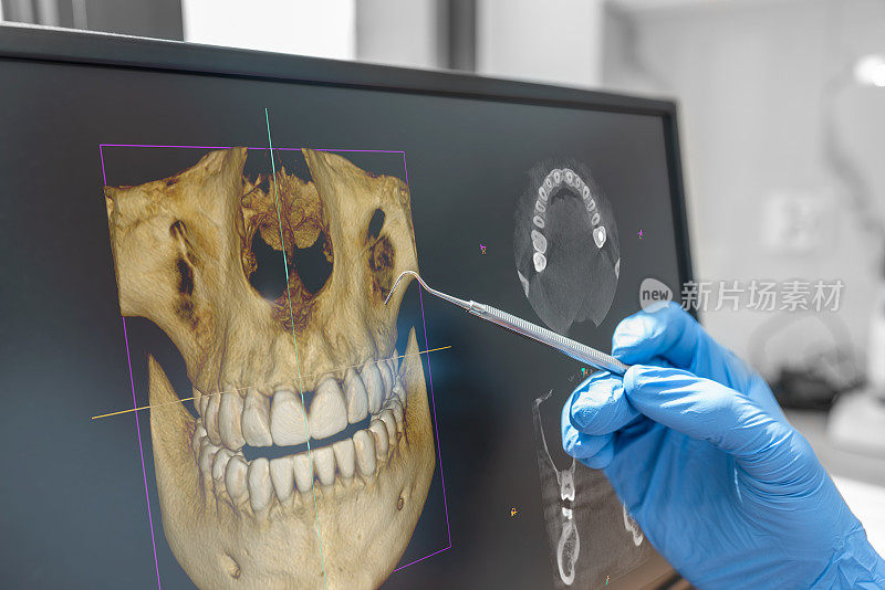 牙科咨询与3D断层扫描图像