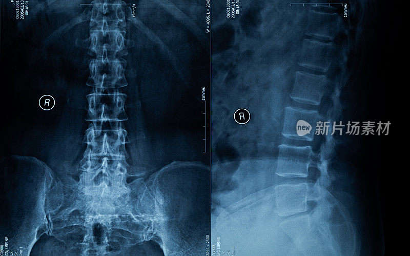 脊柱x射线胶片