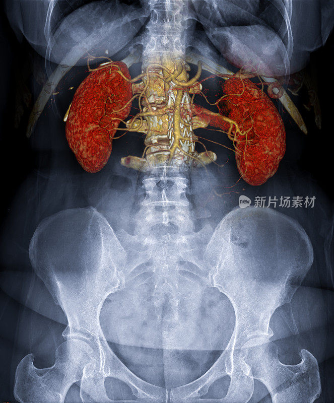 CTA腹主动脉三维成像与腹部x线图像融合。