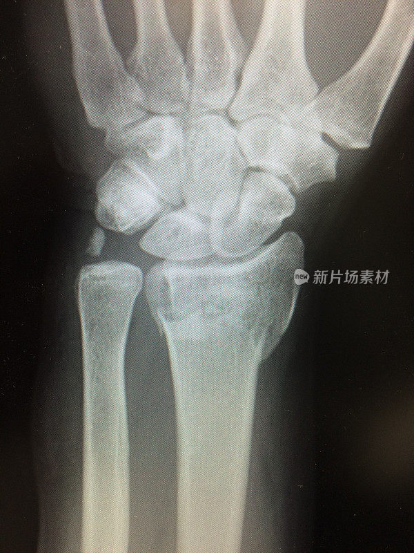 手掌桡骨远端colle骨折的手腕x光片