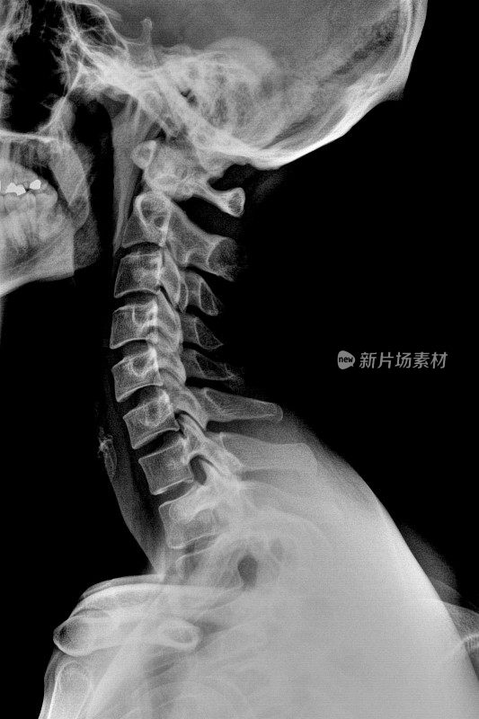 颈椎x线照片