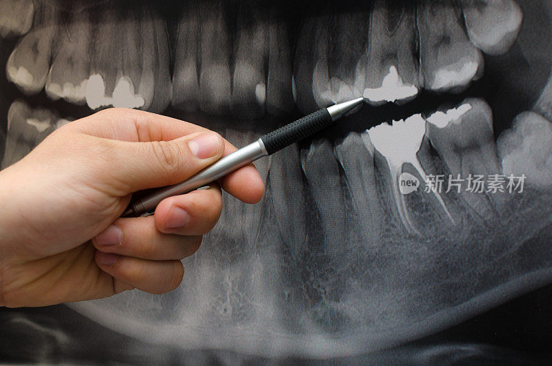 牙科医生在牙科x光图像上显示了一些东西