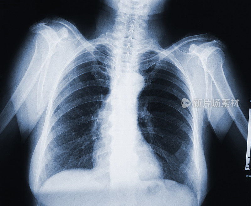 x射线的胸腔