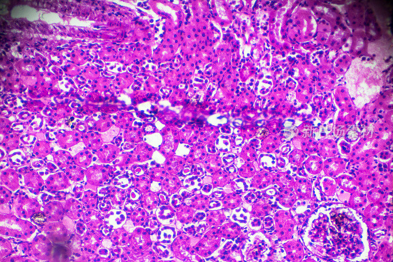 显微镜下急性肾盂肾炎活检标本
