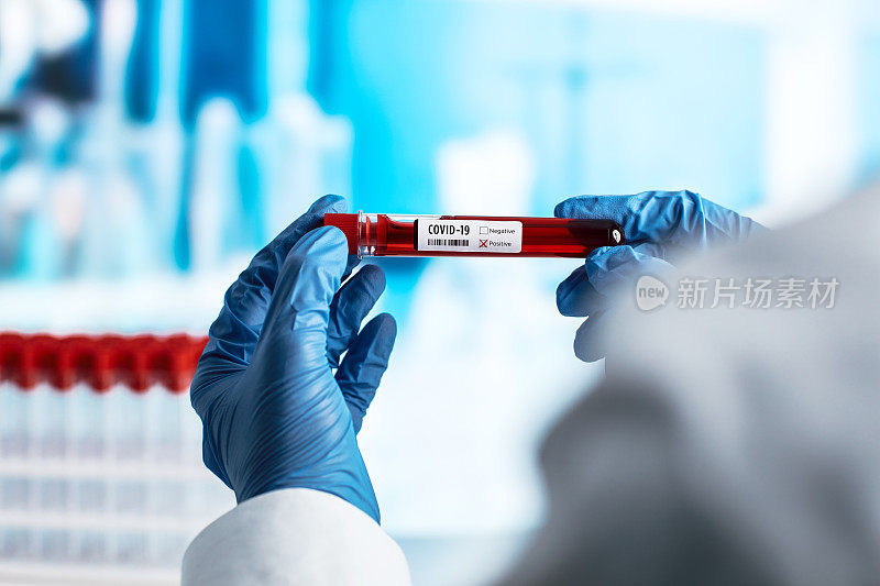 冠状病毒血液检测在医院实验室库存照片