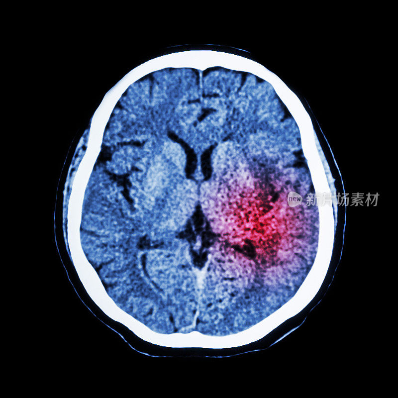 脑CT扫描显示出缺血性卒中或出血性卒中