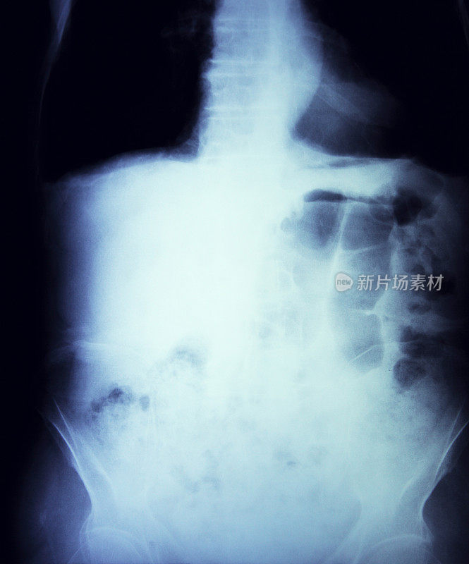 腹部及肺部x光片