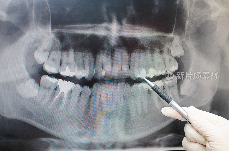 牙科医生在牙科x光图像上显示了一些东西