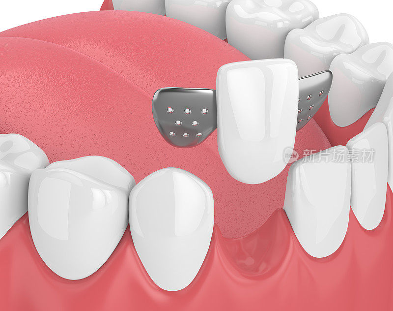 颌骨的3d渲染与牙齿和马里兰桥