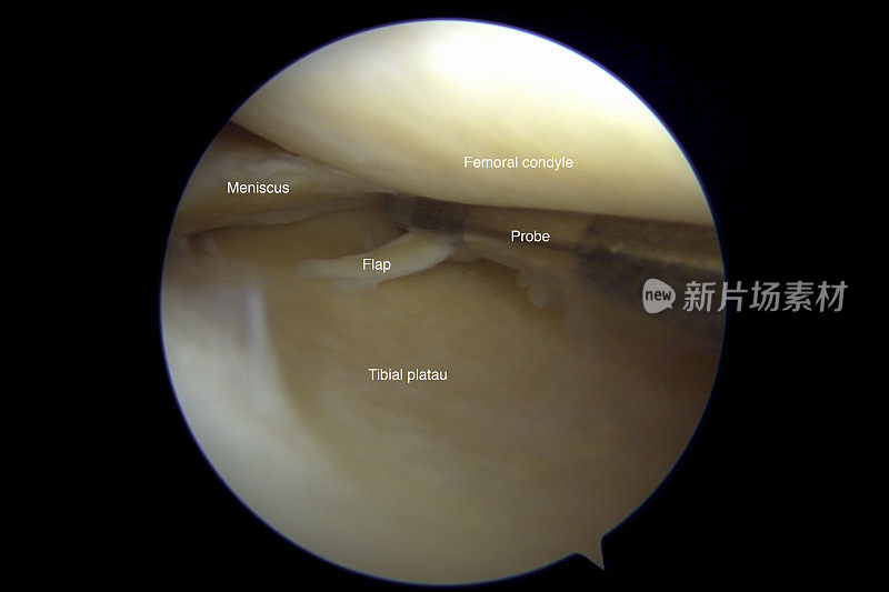 右膝内侧半月板后部皮瓣撕裂的关节镜观察