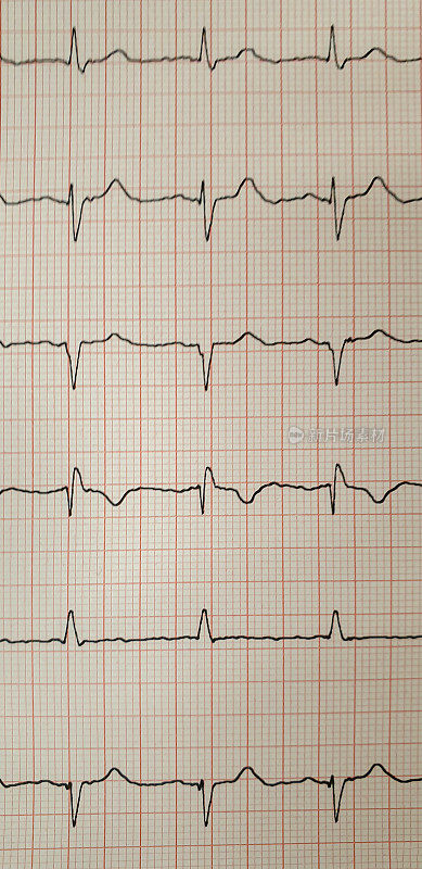 纸上心电图的特写