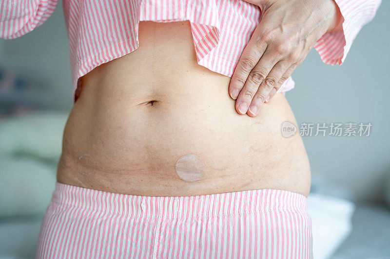 亚洲女人的腹部。激素替代疗法贴片