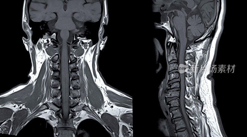 颈椎MRI或颈椎MRI冠状面和矢状面对颈椎病和压缩性骨折的诊断。