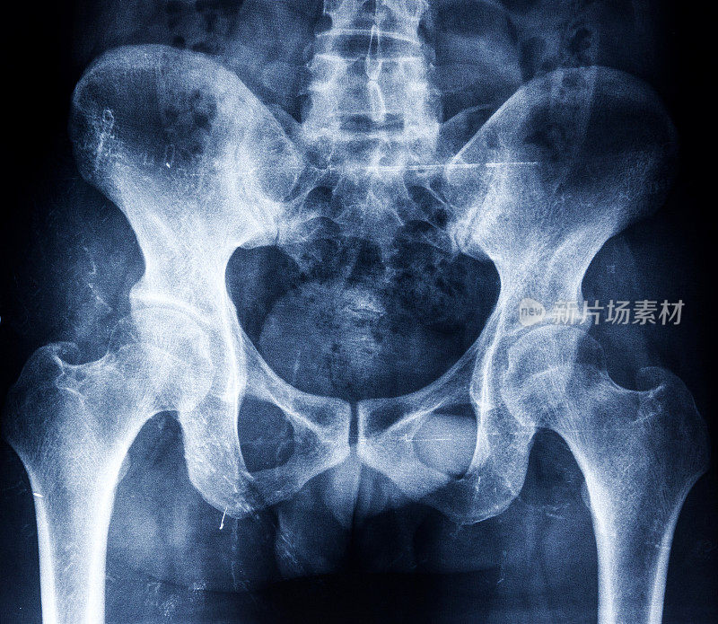 显示骨骼的人类骨盆x光片