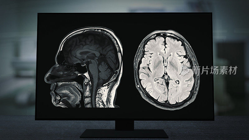 CT脑部扫描图像的磁共振成像(MRI)监视器