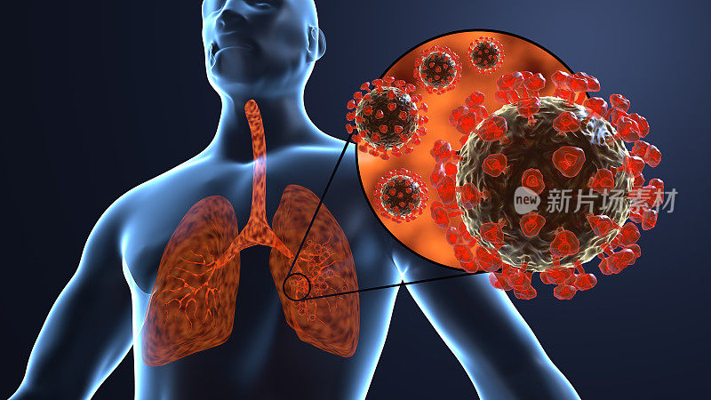 新型冠状病毒Covid-19入侵人体肺部