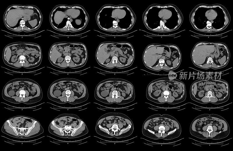 腹部骨盆Cat扫描俯视图