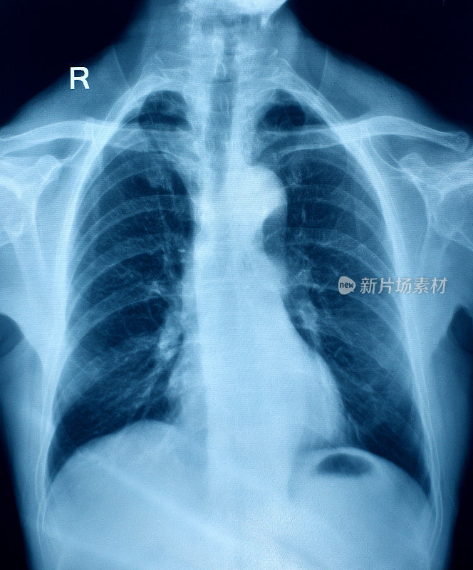 胸部x光图像