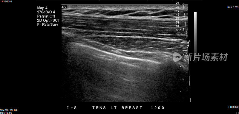 乳房超声检查