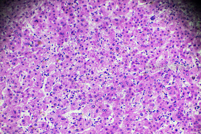 肝细胞癌，显微镜下的HCC
