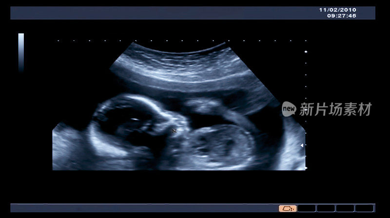 产科超声。一个四个月胎儿的超声检查