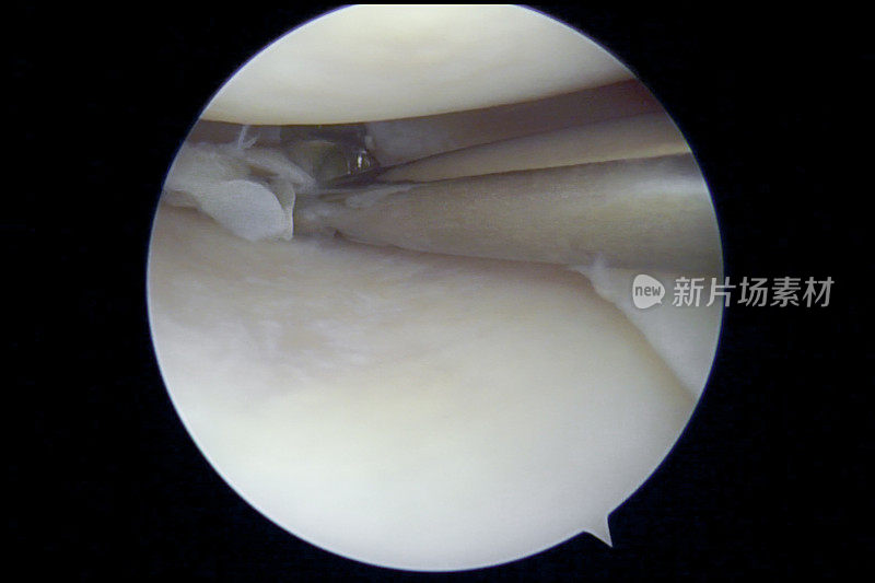 右膝急性创伤性半月板撕裂患者的内侧半月板部分切除术