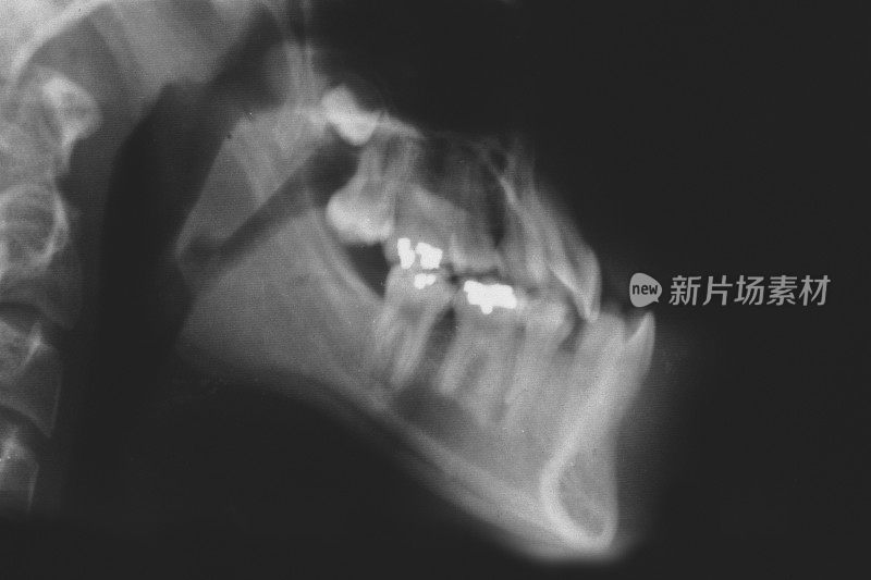 病理性下颌突是一种潜在的毁容遗传疾病，在那里下颌超过了上下颌，导致下巴的延伸。