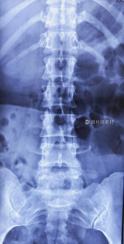 腰骶骨x线正位图。木材脊椎病。矫正腰椎前凸弯曲，减少L5-S1节段椎间盘间隙。