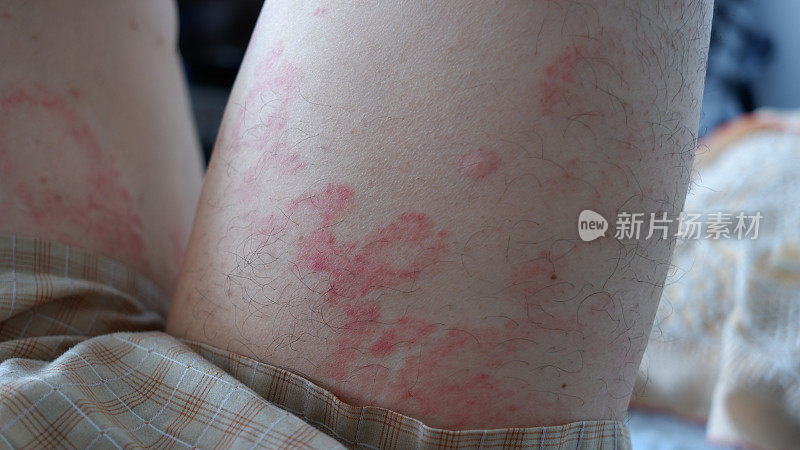 男人大腿上的荨麻疹或卡里塔。过敏症状。
