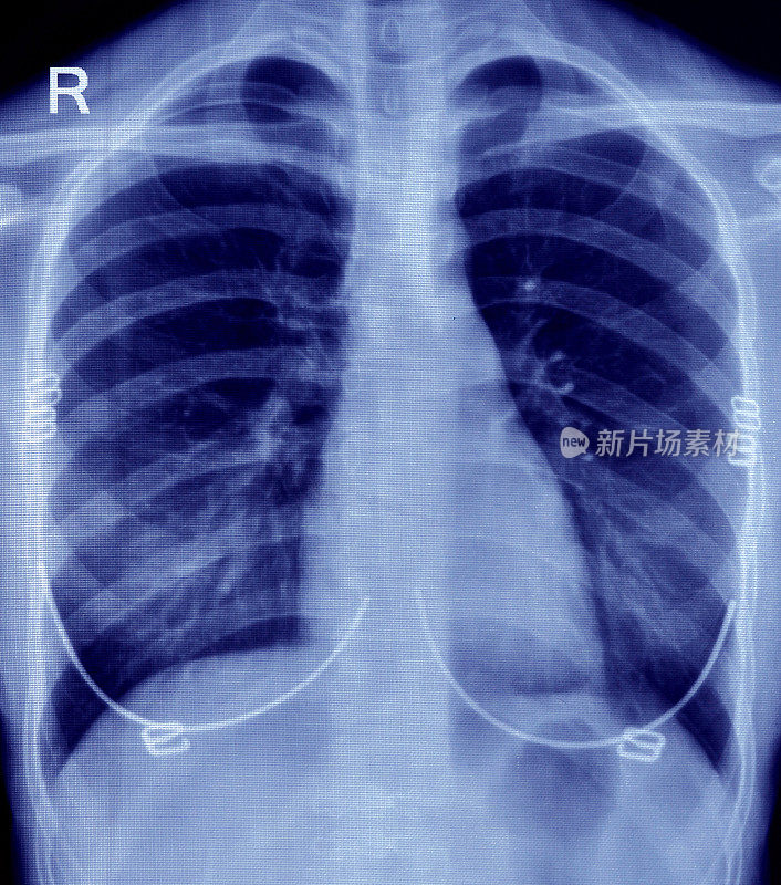 胸部x光图像