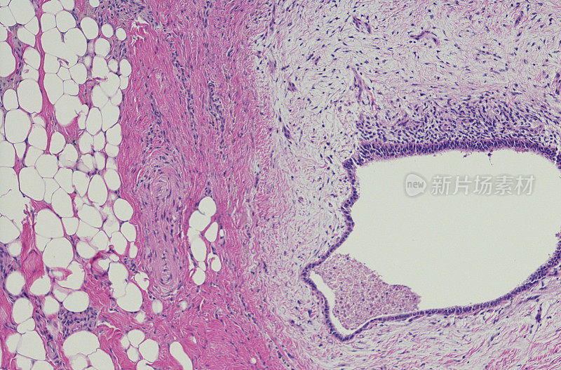 子宫内膜异位症的显微照片