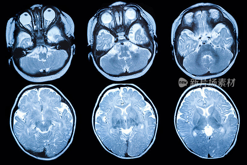 婴儿脑部MRI显示脑白质病变和发育异常