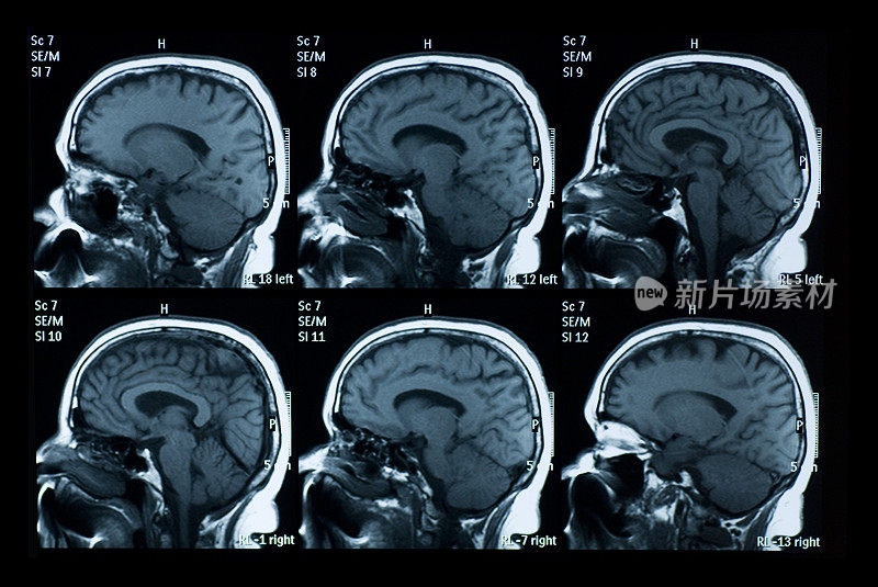 脑MRI扫描