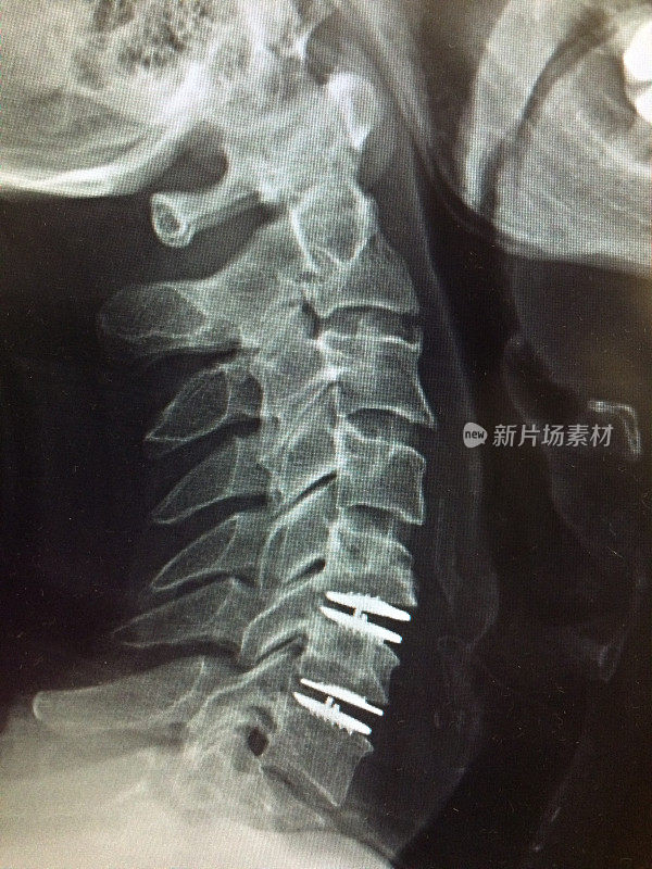 2节段颈椎人工椎间盘置换术