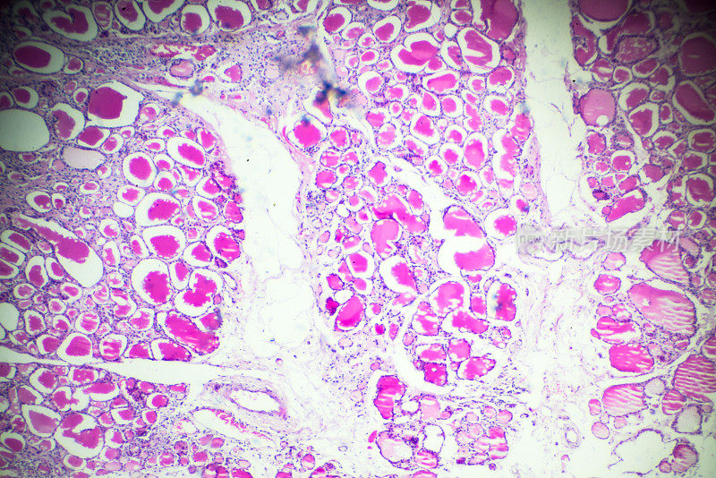 显微镜下的单纯甲状腺肿