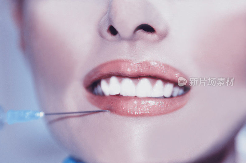 用注射透明质酸填充剂的注射器进行唇部美容。