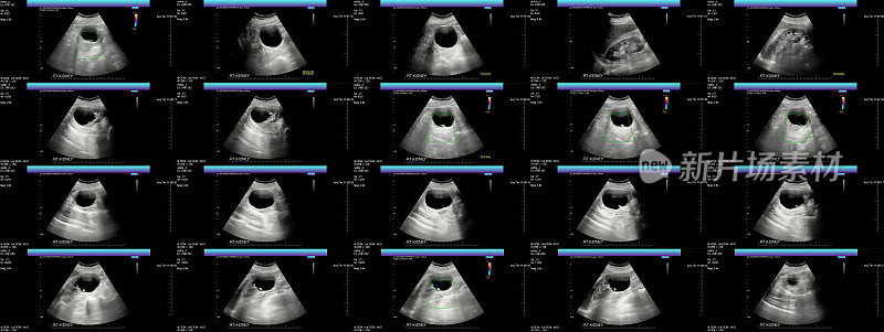 右肾超声序列