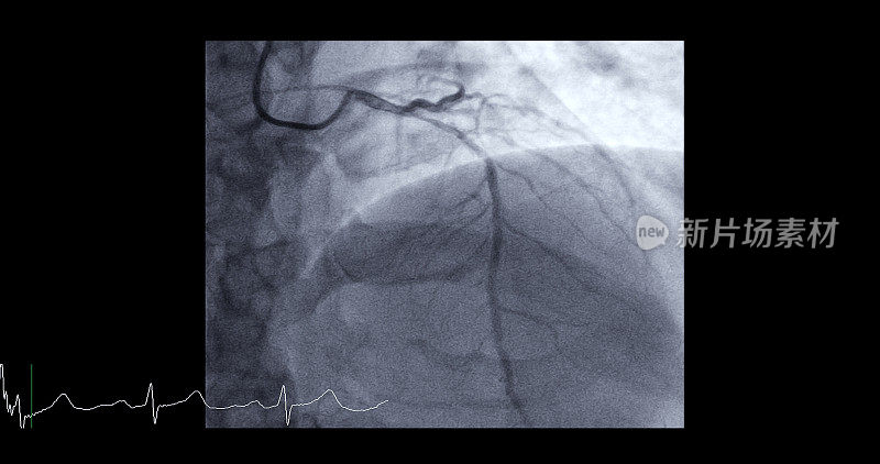 左前降支(LAD)心导管检查可以帮助医生诊断和治疗心脏和血管的问题，如心脏病发作或中风。