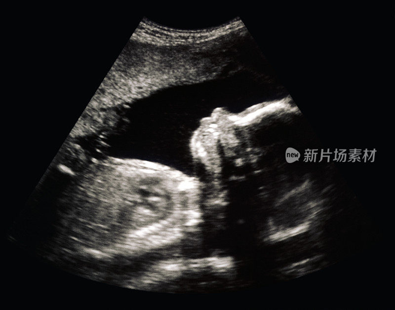 子宫内胎儿的超声波