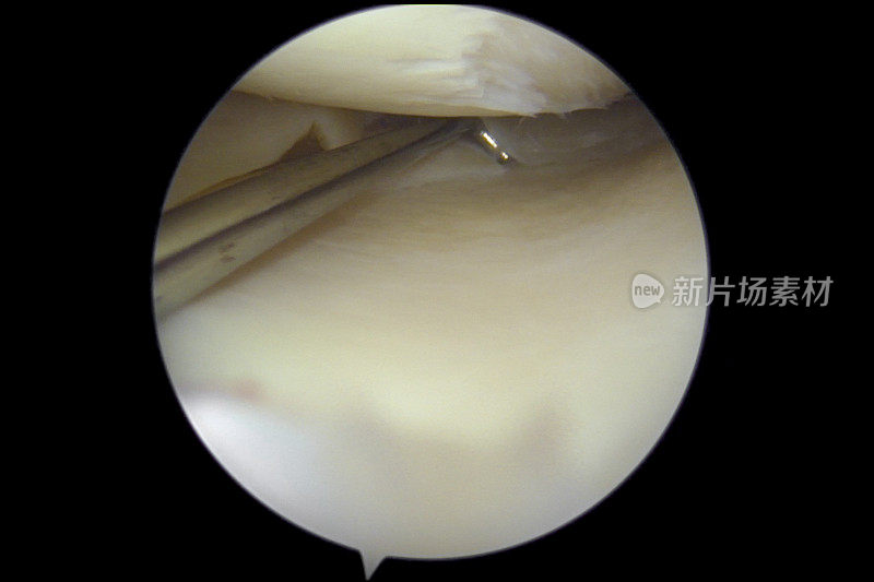 膝关节镜检查显示半月板撕裂和关节软骨缺损