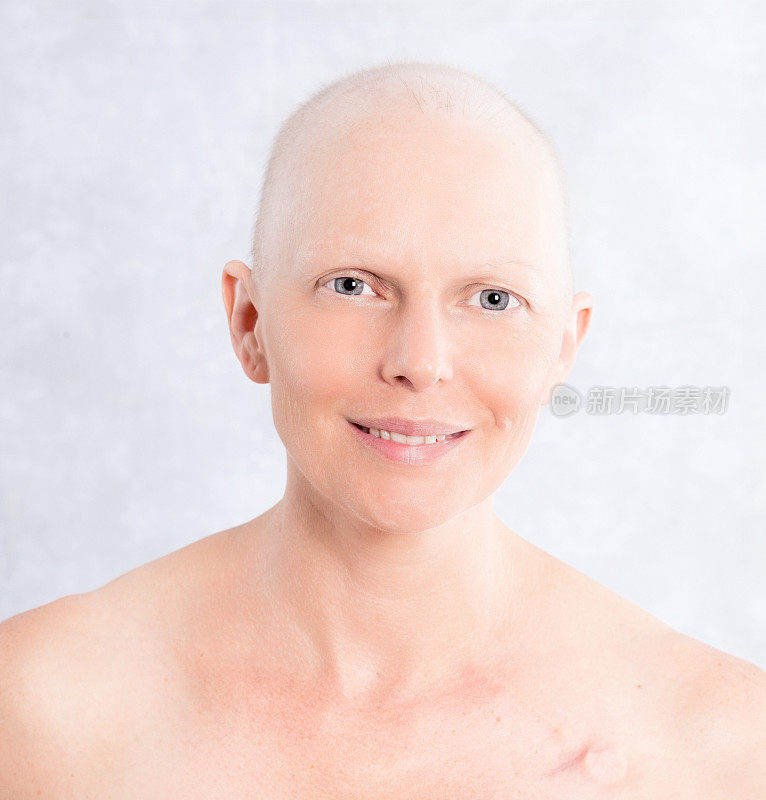 一个带导管的秃顶乳腺癌患者的肖像
