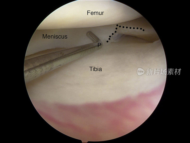 膝关节半月板横向撕裂的关节镜观察