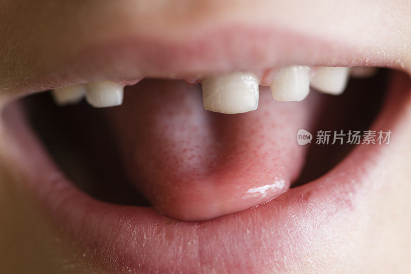 儿童主齿列有齿隙的口腔