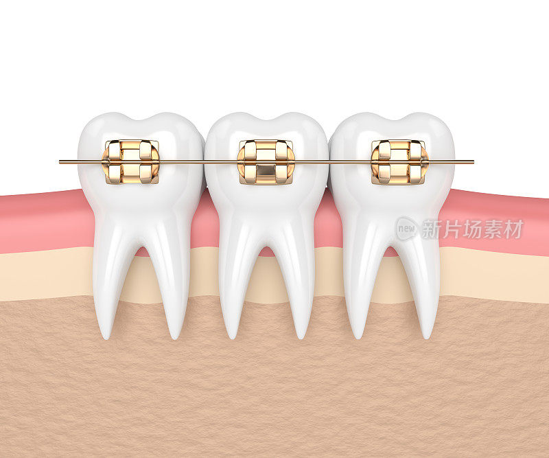 3d渲染的牙齿与黄金矫正牙套