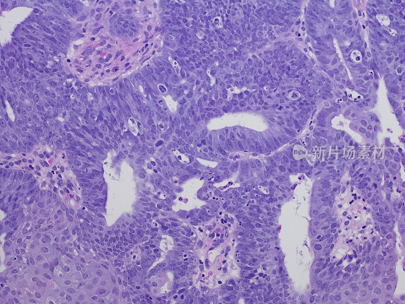 腺癌,子宫内膜endometrioid